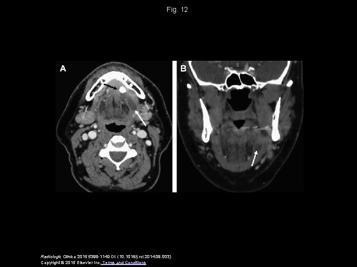 Fig. 12 Radiologic Clinics 2015 5399 -114 DOI: (10. 1016/j. rcl. 2014. 09. 003)