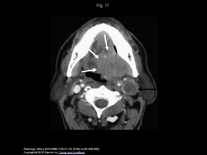 Fig. 17 Radiologic Clinics 2015 5399 -114 DOI: (10. 1016/j. rcl. 2014. 09. 003)