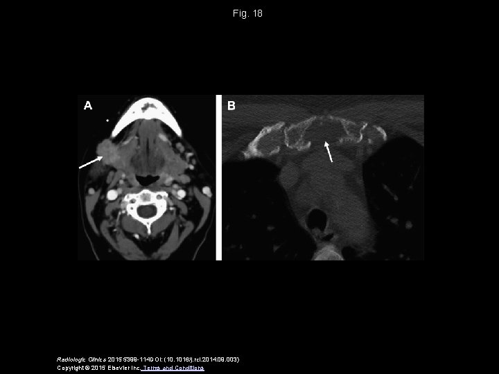 Fig. 18 Radiologic Clinics 2015 5399 -114 DOI: (10. 1016/j. rcl. 2014. 09. 003)