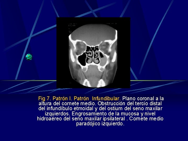 Fig 7. Patrón Infundibular. Plano coronal a la altura del cornete medio. Obstrucción del Fig 7. Patrón Infundibular. Plano coronal a la altura del cornete medio. Obstrucción del