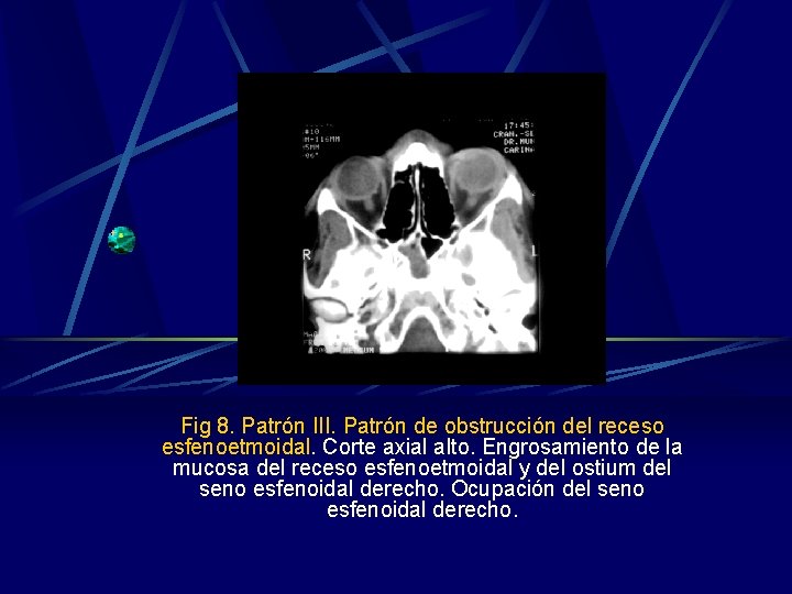Fig 8. Patrón III. Patrón de obstrucción del receso esfenoetmoidal. Corte axial alto. Engrosamiento Fig 8. Patrón III. Patrón de obstrucción del receso esfenoetmoidal. Corte axial alto. Engrosamiento