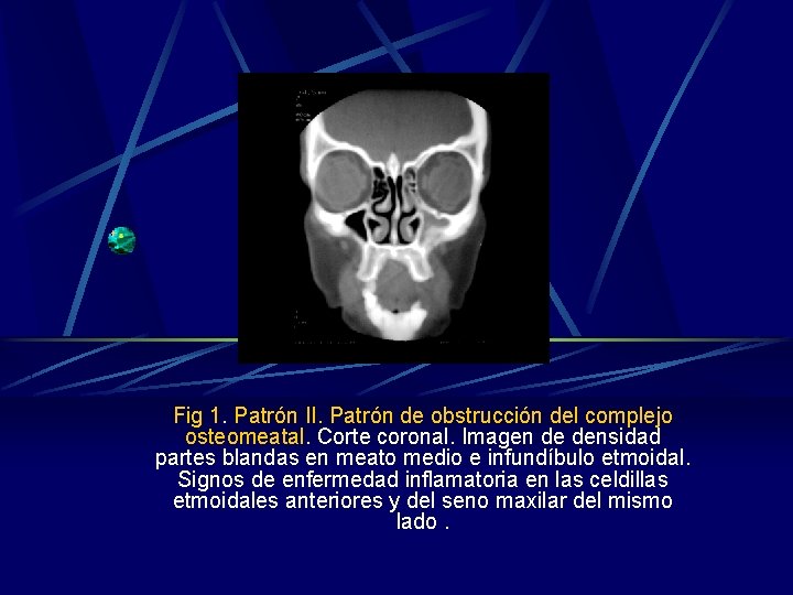 Fig 1. Patrón II. Patrón de obstrucción del complejo osteomeatal. Corte coronal. Imagen de Fig 1. Patrón II. Patrón de obstrucción del complejo osteomeatal. Corte coronal. Imagen de