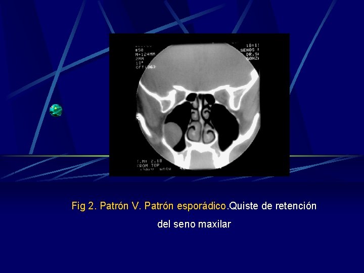 Fig 2. Patrón V. Patrón esporádico. Quiste de retención del seno maxilar Fig 2. Patrón V. Patrón esporádico. Quiste de retención del seno maxilar