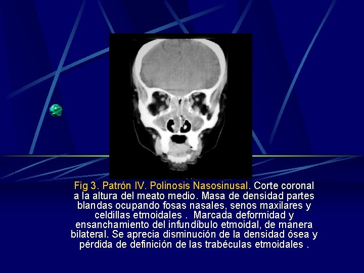 Fig 3. Patrón IV. Polinosis Nasosinusal. Corte coronal a la altura del meato medio. Fig 3. Patrón IV. Polinosis Nasosinusal. Corte coronal a la altura del meato medio.