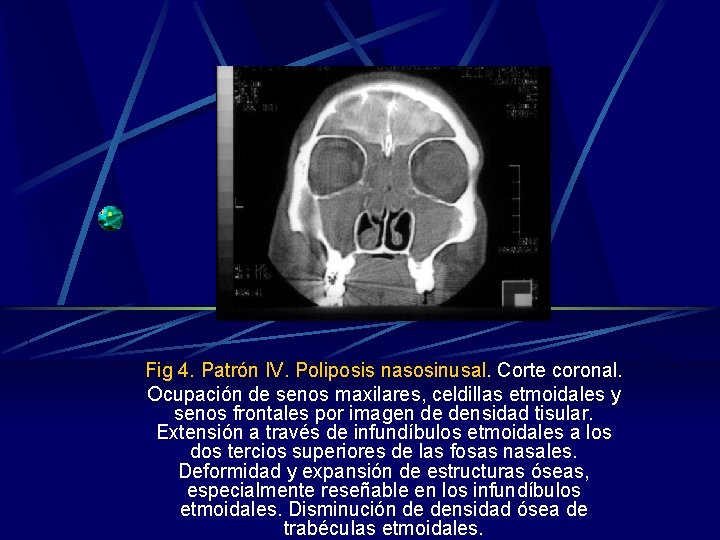 Fig 4. Patrón IV. Poliposis nasosinusal. Corte coronal. Ocupación de senos maxilares, celdillas etmoidales Fig 4. Patrón IV. Poliposis nasosinusal. Corte coronal. Ocupación de senos maxilares, celdillas etmoidales
