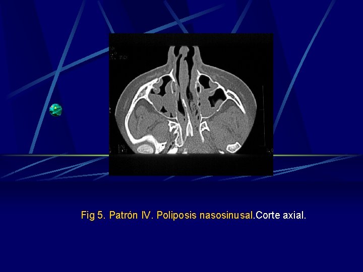 Fig 5. Patrón IV. Poliposis nasosinusal. Corte axial. Fig 5. Patrón IV. Poliposis nasosinusal. Corte axial.