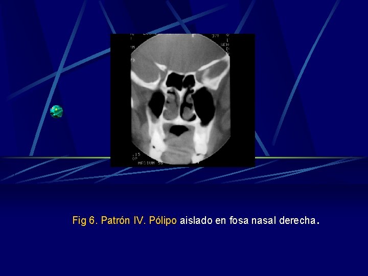 Fig 6. Patrón IV. Pólipo aislado en fosa nasal derecha . Fig 6. Patrón IV. Pólipo aislado en fosa nasal derecha .