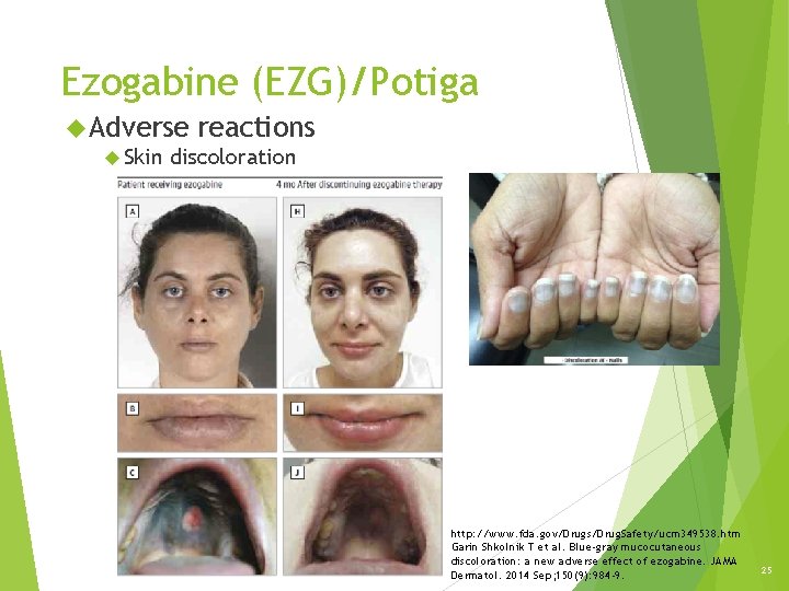 Ezogabine (EZG)/Potiga Adverse Skin reactions discoloration http: //www. fda. gov/Drugs/Drug. Safety/ucm 349538. htm Garin Ezogabine (EZG)/Potiga Adverse Skin reactions discoloration http: //www. fda. gov/Drugs/Drug. Safety/ucm 349538. htm Garin