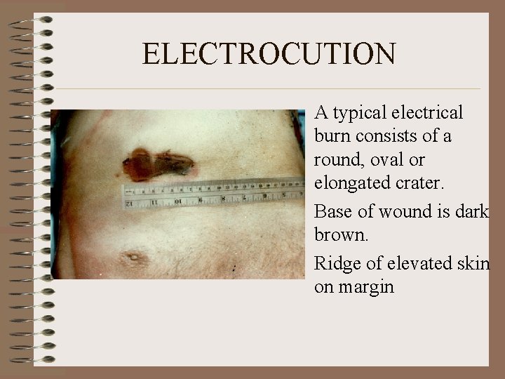 ELECTROCUTION • A typical electrical burn consists of a round, oval or elongated crater.