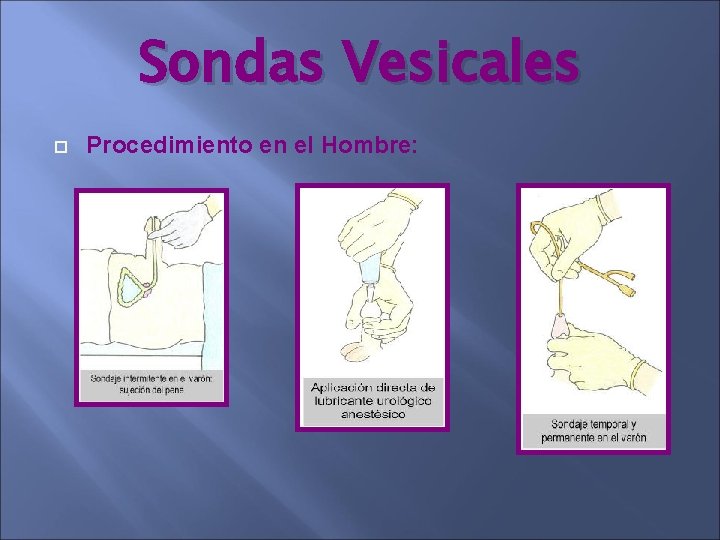 Sondas Vesicales Procedimiento en el Hombre: Sondas Vesicales Procedimiento en el Hombre: