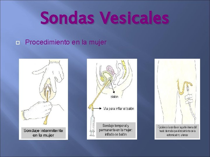 Sondas Vesicales Procedimiento en la mujer Sondas Vesicales Procedimiento en la mujer