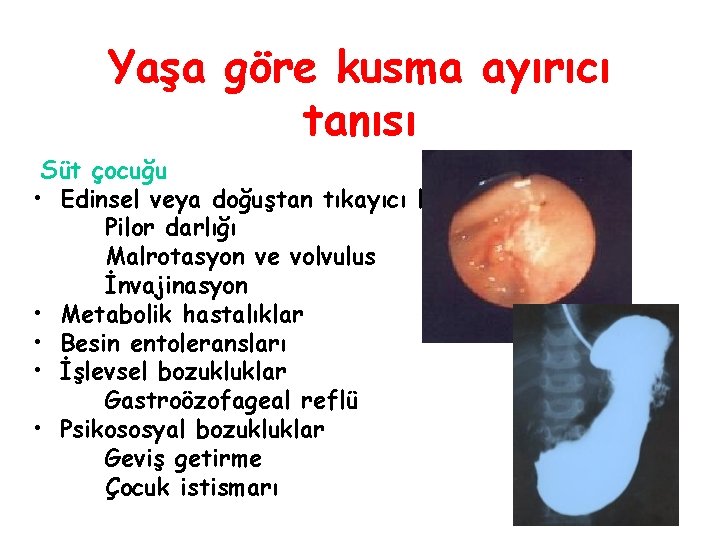 Yaşa göre kusma ayırıcı tanısı Süt çocuğu • Edinsel veya doğuştan tıkayıcı lezyonlar Pilor