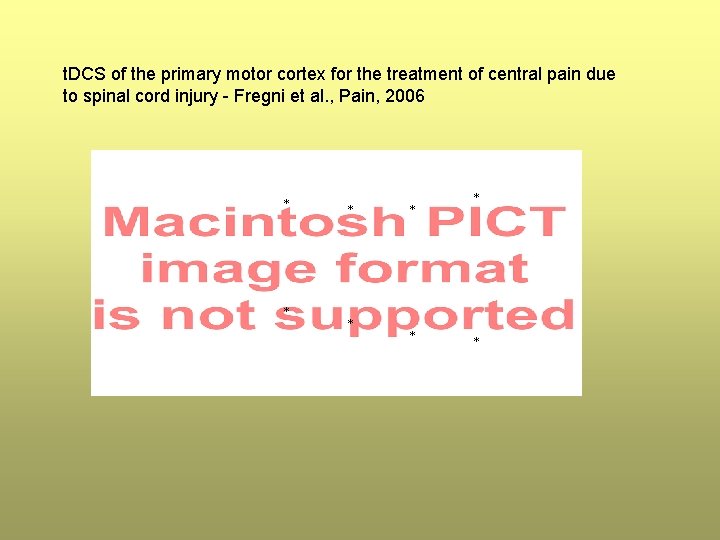 t. DCS of the primary motor cortex for the treatment of central pain due t. DCS of the primary motor cortex for the treatment of central pain due