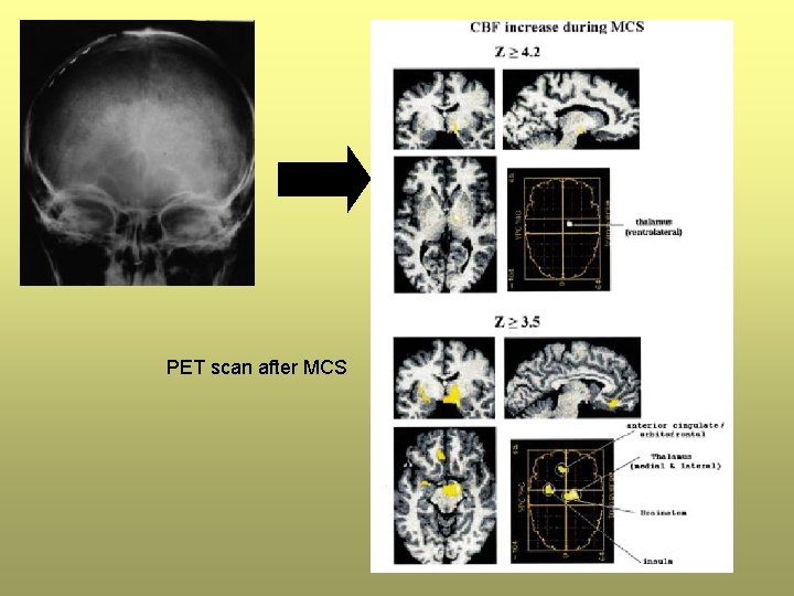 PET scan after MCS PET scan after MCS