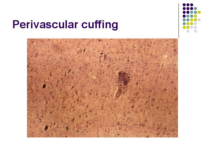 Perivascular cuffing 