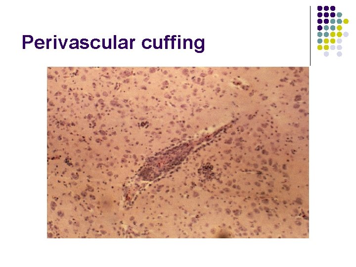 Perivascular cuffing 