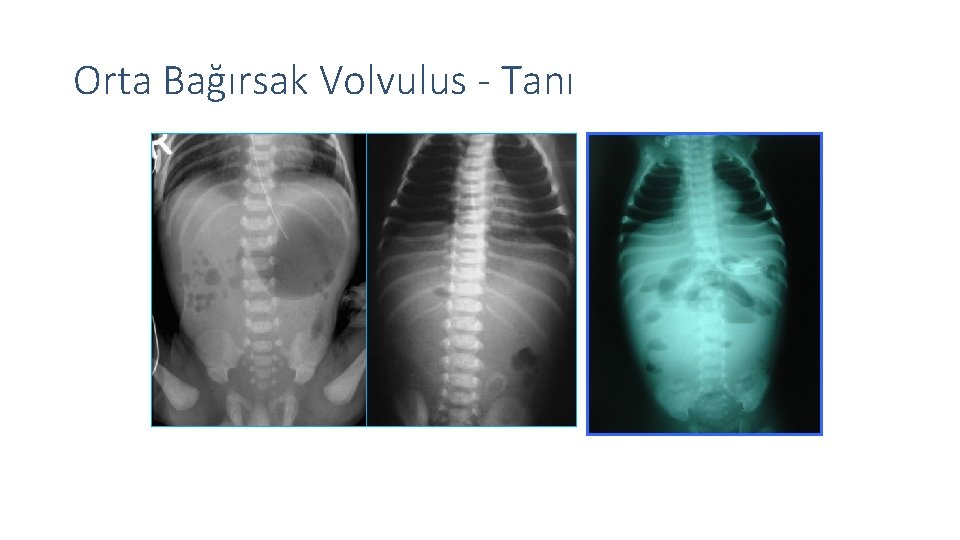 Orta Bağırsak Volvulus - Tanı 