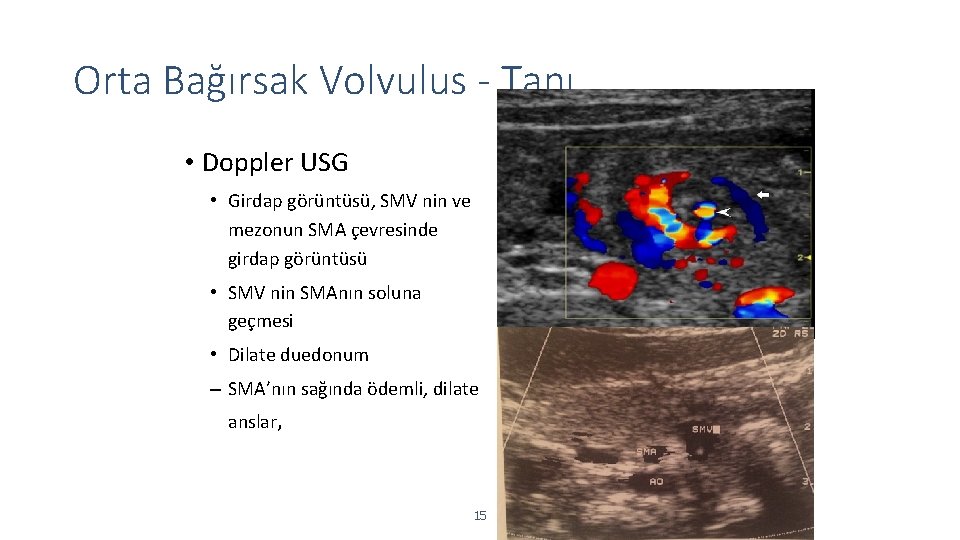 Orta Bağırsak Volvulus - Tanı • Doppler USG • Girdap görüntüsü, SMV nin ve