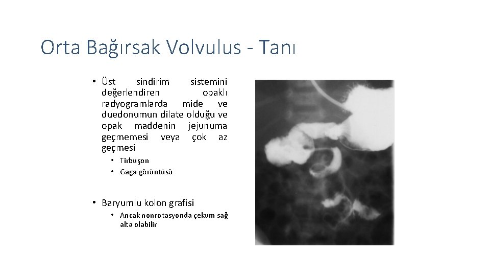 Orta Bağırsak Volvulus - Tanı • Üst sindirim sistemini değerlendiren opaklı radyogramlarda mide ve