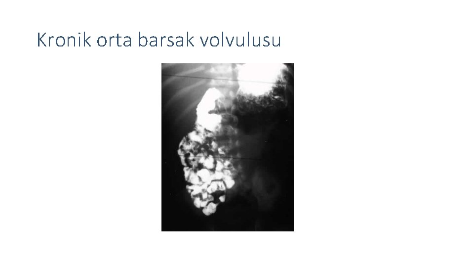 Kronik orta barsak volvulusu 