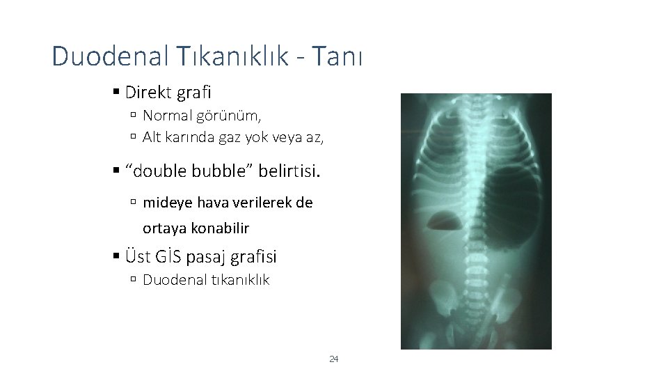 Duodenal Tıkanıklık - Tanı Direkt grafi Normal görünüm, Alt karında gaz yok veya az,