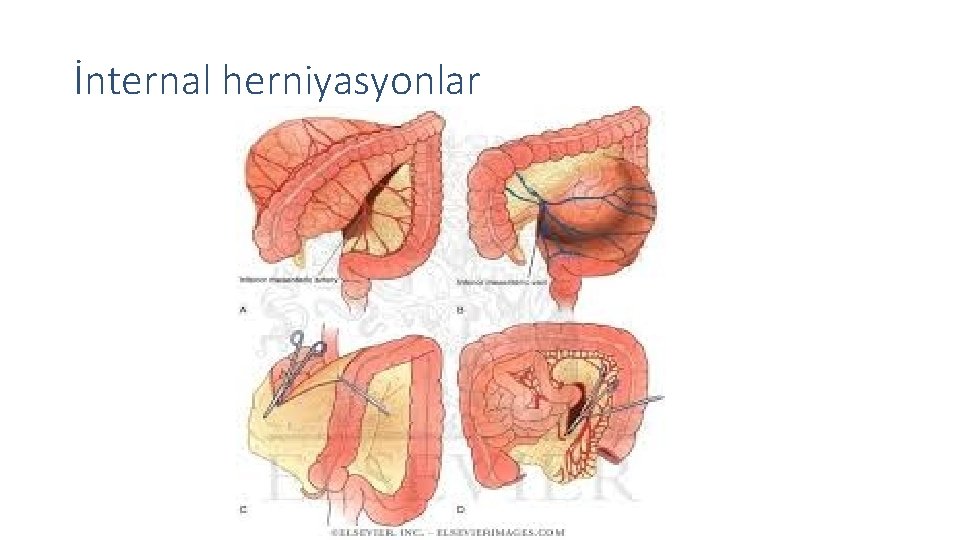 İnternal herniyasyonlar 