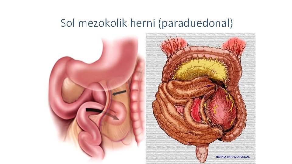 Sol mezokolik herni (paraduedonal) 