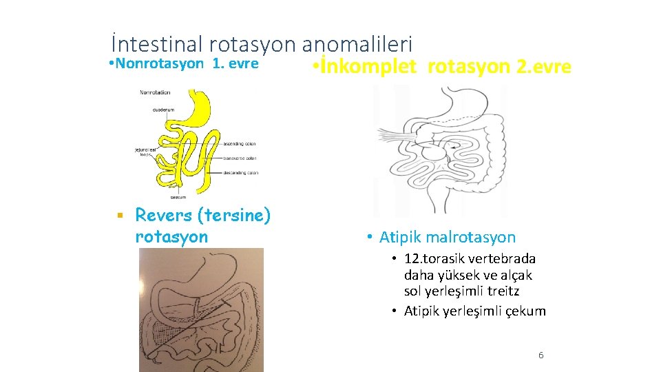 İntestinal rotasyon anomalileri • Nonrotasyon 1. evre Revers (tersine) rotasyon • İnkomplet rotasyon 2.