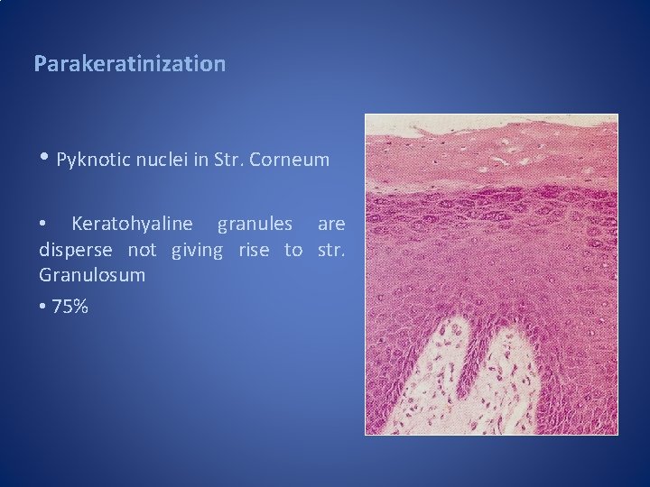 Parakeratinization • Pyknotic nuclei in Str. Corneum • Keratohyaline granules are disperse not giving