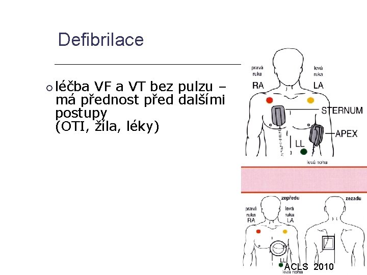 Defibrilace léčba VF a VT bez pulzu – má přednost před dalšími postupy (OTI,