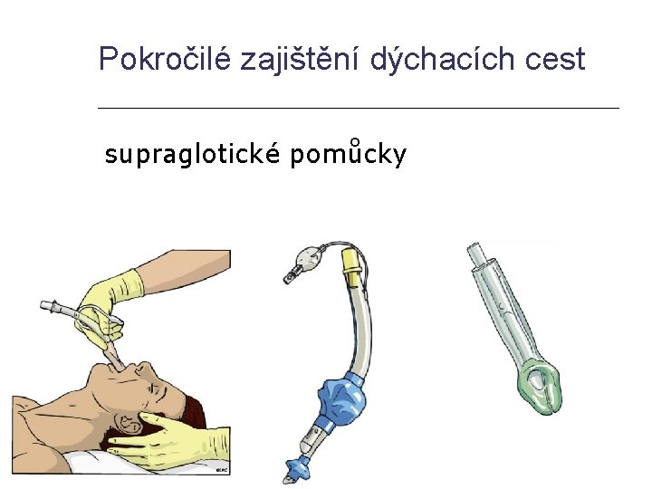 Pokročilé zajištění dýchacích cest supraglotické pomůcky 