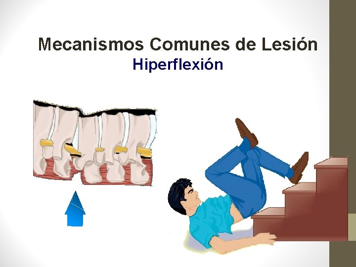 Mecanismos Comunes de Lesión Hiperflexión 