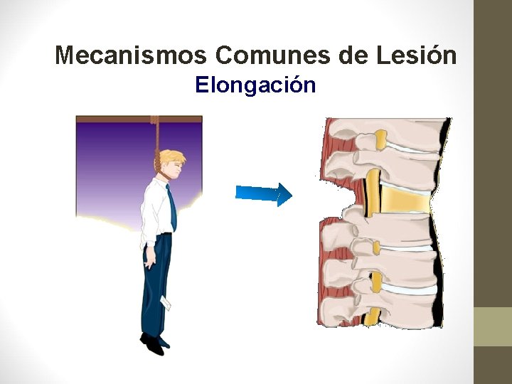 Mecanismos Comunes de Lesión Elongación 