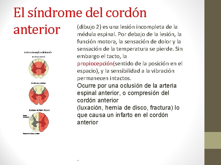 El síndrome del cordón (dibujo 2) es una lesión incompleta de la anterior médula