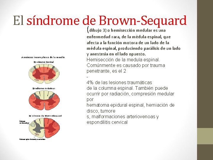 El síndrome de Brown-Sequard (dibujo 3) o hemisección medular es una enfermedad rara, de