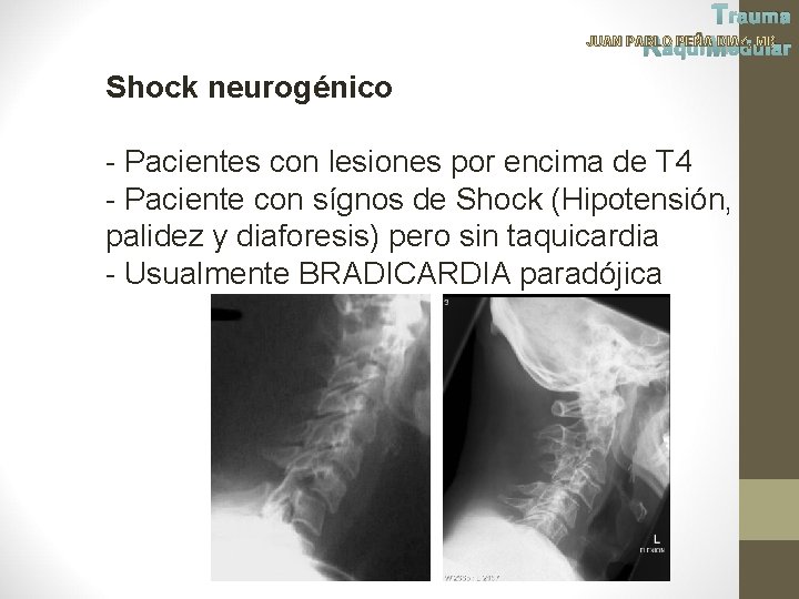 Trauma JUAN PABLO PEÑA DIAZ, MD Raqui Medular Shock neurogénico - Pacientes con lesiones