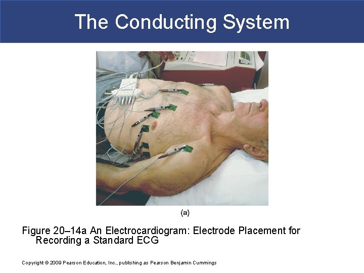 The Conducting System Figure 20– 14 a An Electrocardiogram: Electrode Placement for Recording a