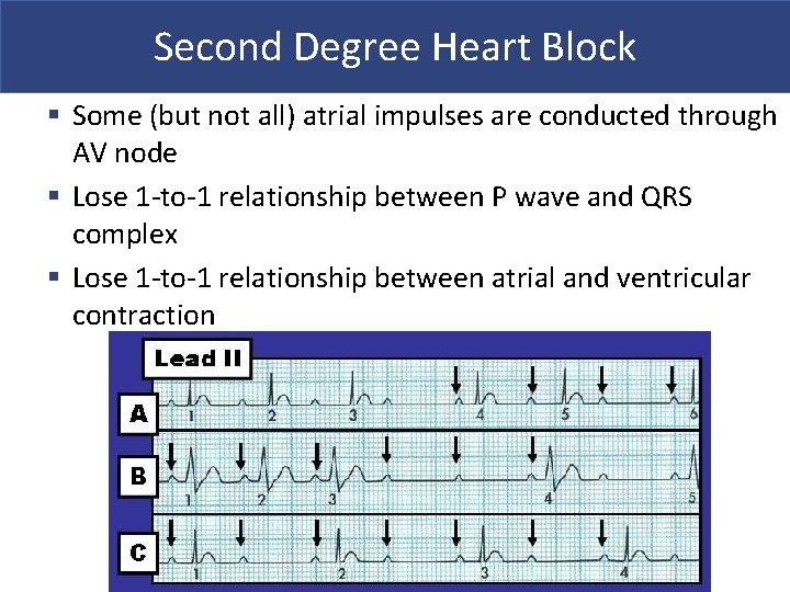 Second Degree Heart Block § Some (but not all) atrial impulses are conducted through