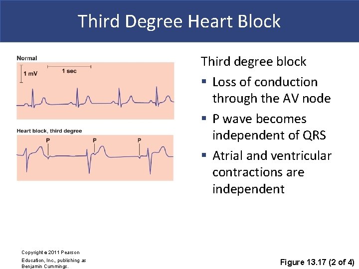 Third Degree Heart Block Third degree block § Loss of conduction through the AV