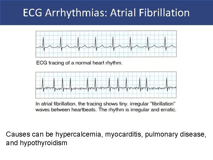 ECG Arrhythmias: Atrial Fibrillation Causes can be hypercalcemia, myocarditis, pulmonary disease, and hypothyroidism 