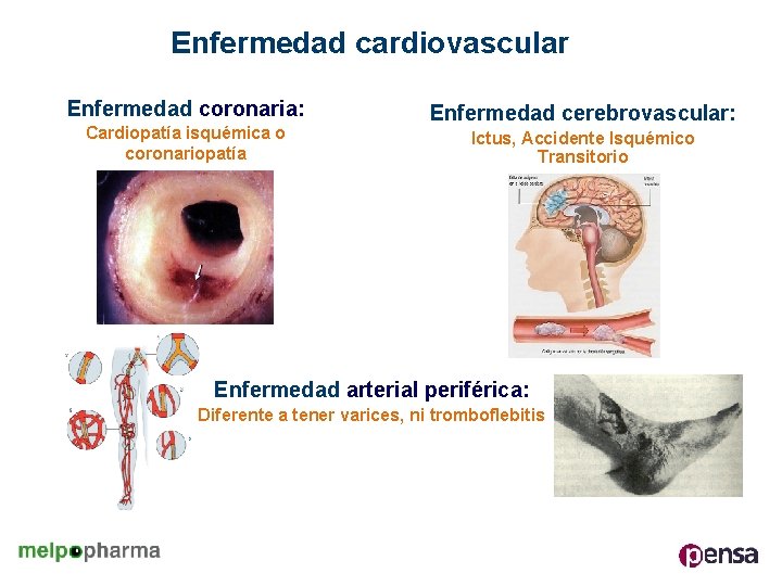 Enfermedad cardiovascular Enfermedad coronaria: Cardiopatía isquémica o coronariopatía Enfermedad cerebrovascular: Ictus, Accidente Isquémico Transitorio