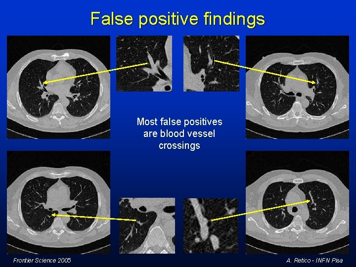 False positive findings Most false positives are blood vessel crossings Frontier Science 2005 A. False positive findings Most false positives are blood vessel crossings Frontier Science 2005 A.