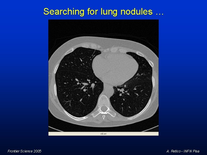 Searching for lung nodules … Frontier Science 2005 A. Retico - INFN Pisa Searching for lung nodules … Frontier Science 2005 A. Retico - INFN Pisa