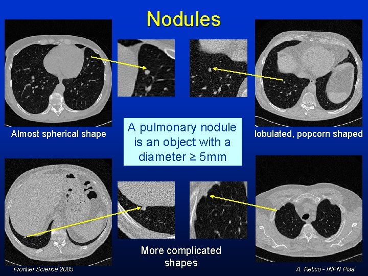Nodules Almost spherical shape Frontier Science 2005 A pulmonary nodule is an object with Nodules Almost spherical shape Frontier Science 2005 A pulmonary nodule is an object with