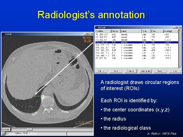 Radiologist’s annotation A radiologist draws circular regions of interest (ROIs) Each ROI is identified Radiologist’s annotation A radiologist draws circular regions of interest (ROIs) Each ROI is identified