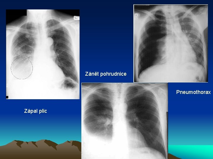 Zánět pohrudnice Pneumothorax Zápal plic 