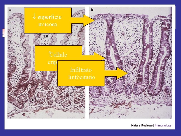  superficie mucosa Cellule criptiche Infiltrato linfocitario 