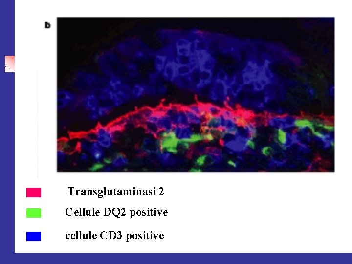 Transglutaminasi 2 Cellule DQ 2 positive cellule CD 3 positive 