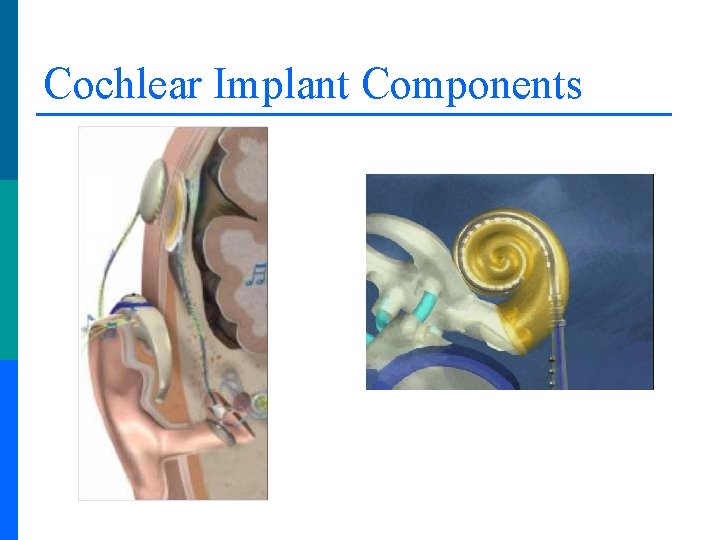 Cochlear Implant Components 