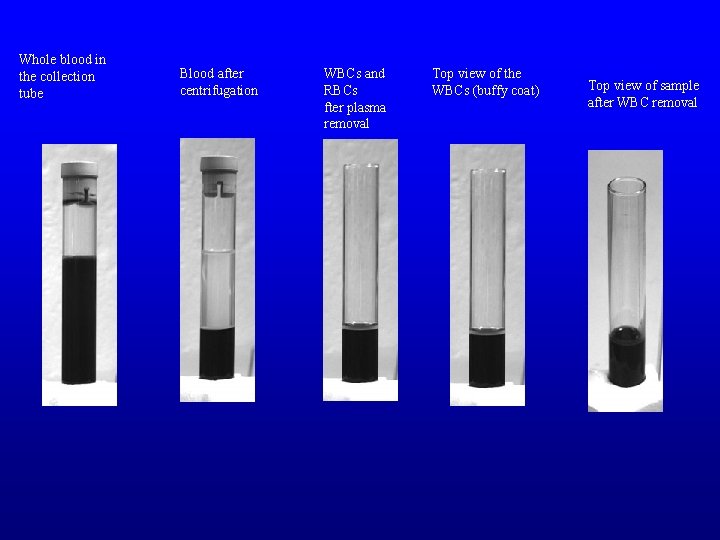 Whole blood in the collection tube Blood after centrifugation WBCs and RBCs fter plasma